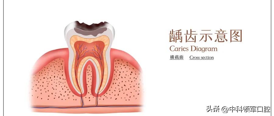 牙齿只剩根部只能拔吗,牙齿只剩根可以做根管吗