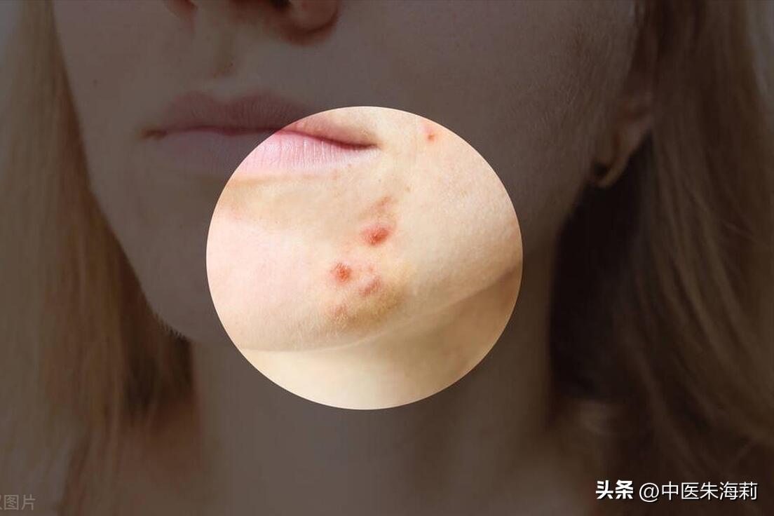 疮疡久不收口的中医治疗,疮疡久不收口中药治疗