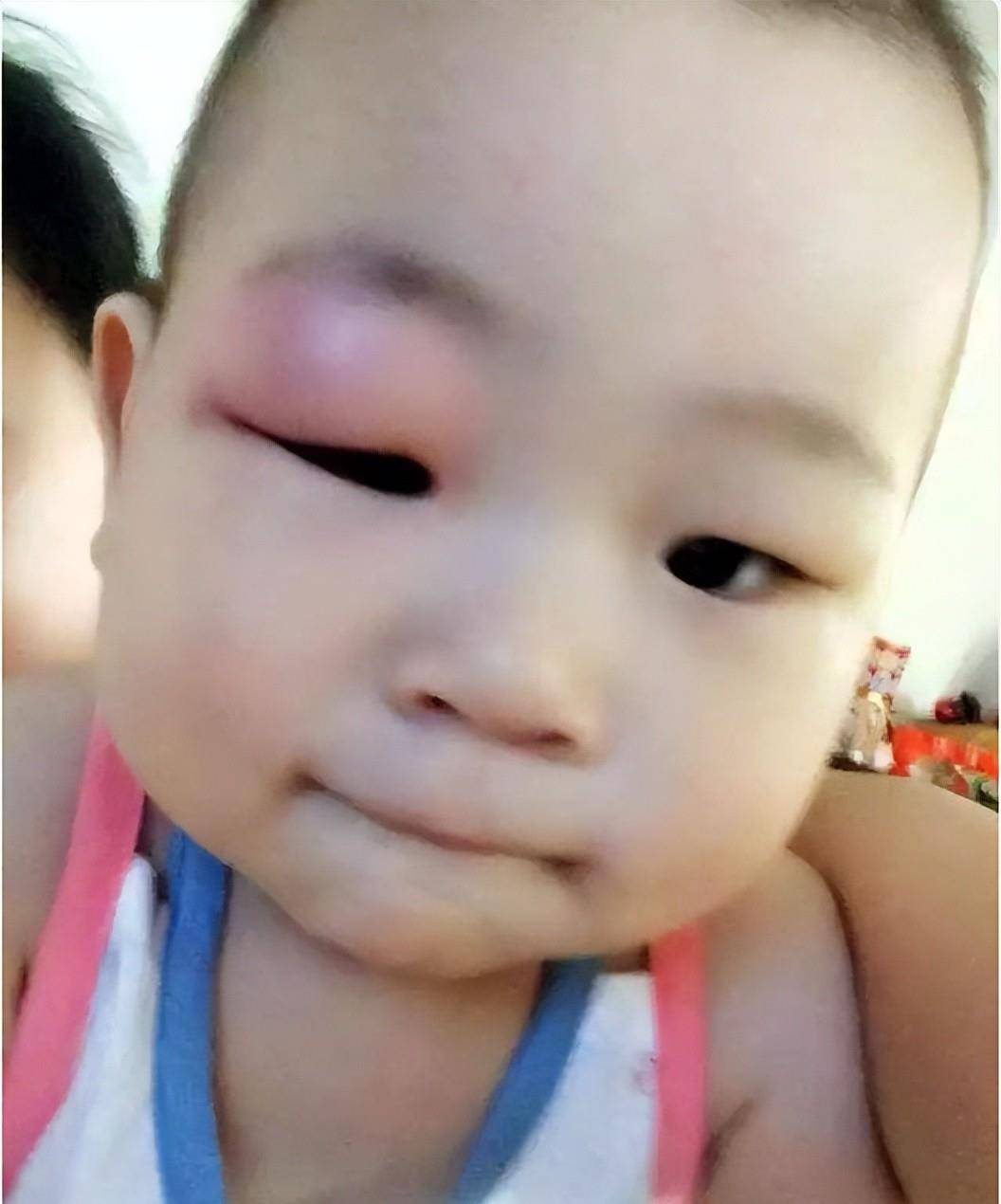 宝宝被蚊子咬了肿痒擦什么,宝宝被蚊子咬特别肿怎么办