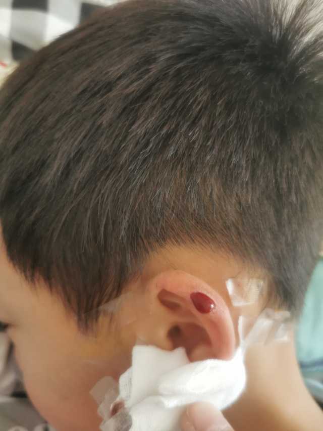 小男孩理发被剃秃,小孩耳朵被理发店剪破了皮