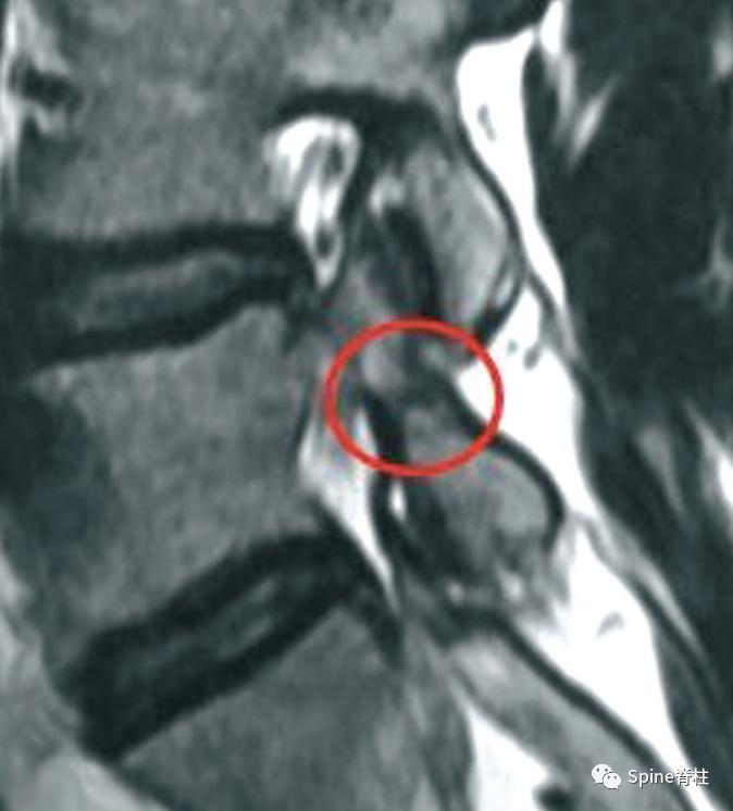峡部裂和隐性峡部裂有区别吗,单纯峡部裂可以做峡部修复吗