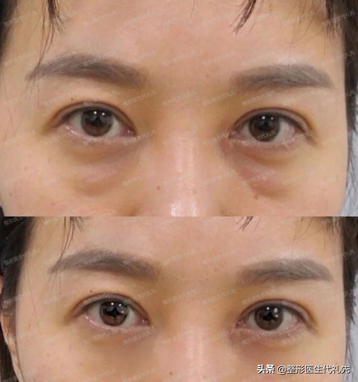 40岁以后为什么眼睛变小了,年轻人眼睛变小了怎么回事