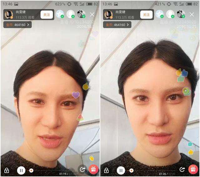 假下巴前后对比,假下巴