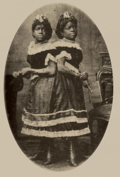 连体双胞胎姐妹的悲惨人生,双胞胎姐妹一个死亡后续