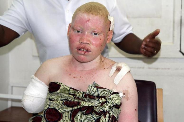 非洲版唐僧：血液堪比钻石，躯干价值126万元，警方24小时守卫