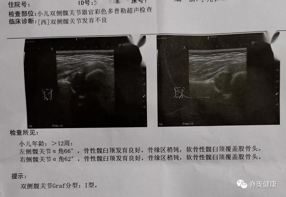 脊奥健康｜婴幼儿矫正案例—先天性髋关节发育不良+Tübingen支具