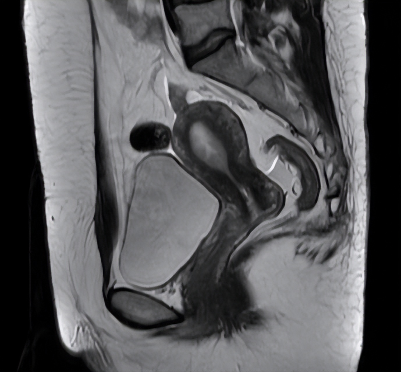 HPV16感染七年，复查后发现宫颈癌，定期随诊成关键