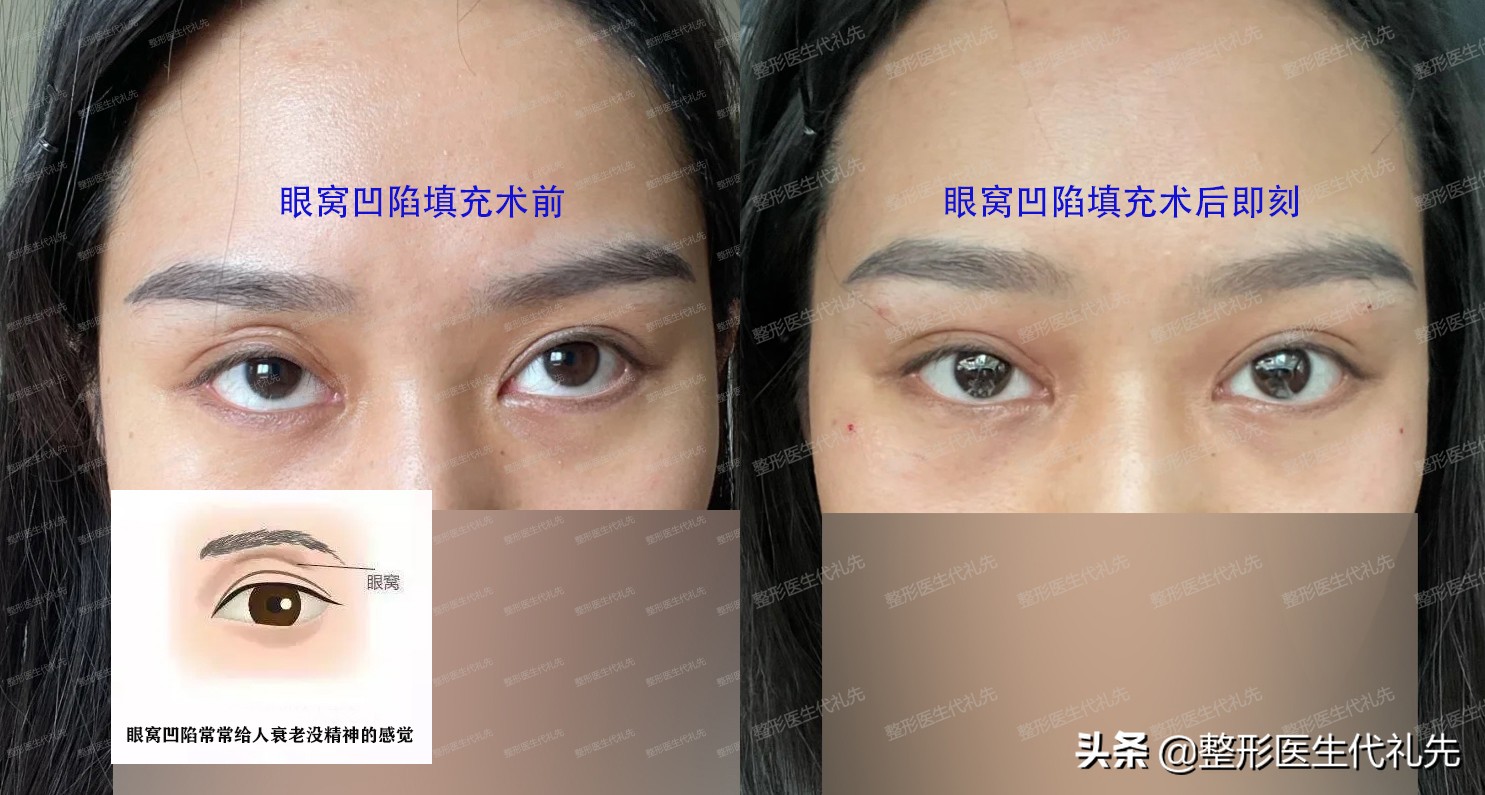 上眼窝凹陷下眼窝水肿怎么回事,眼窝凹陷眼周脂肪填充眼窝可以吗