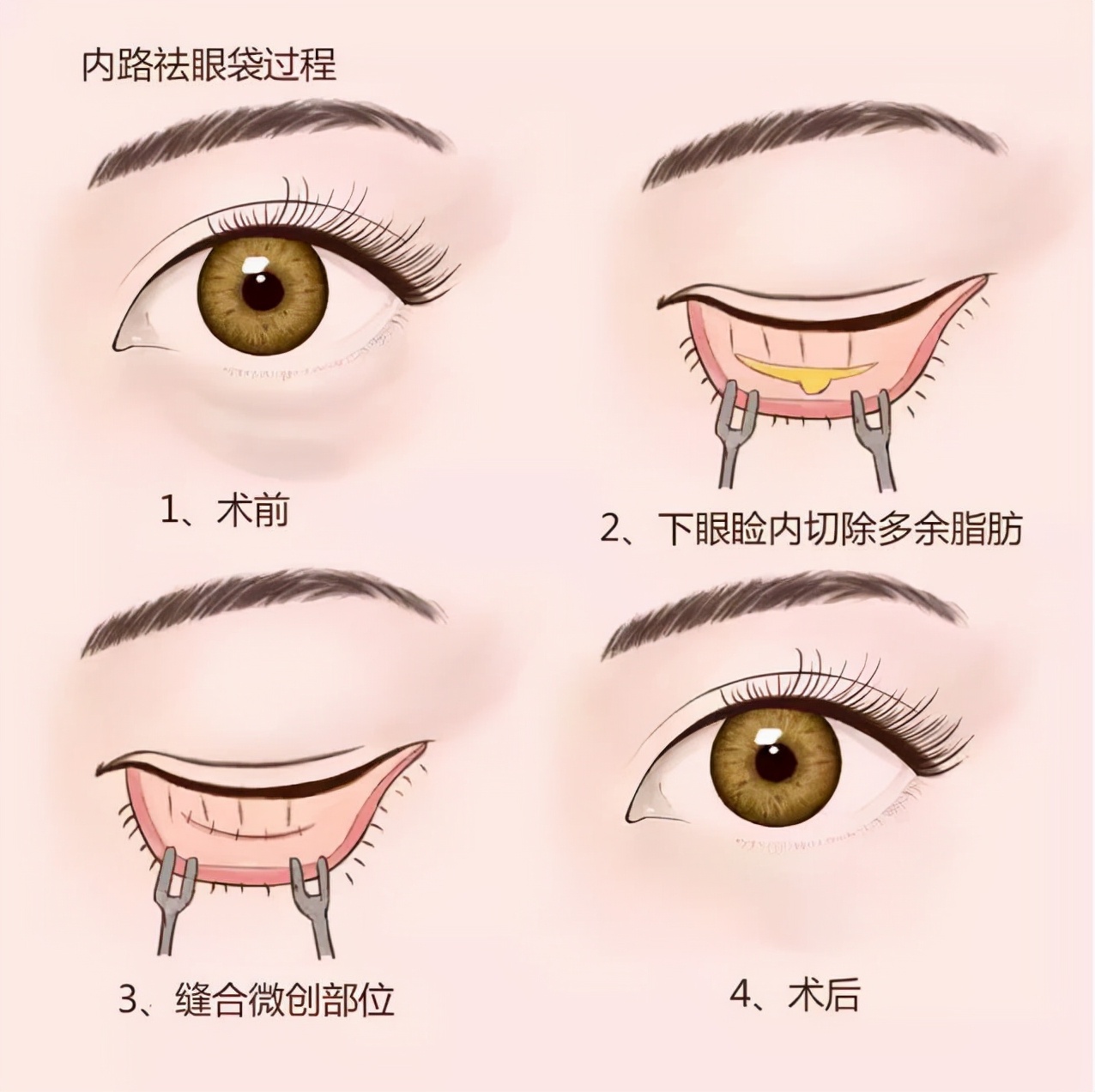 上海第九人民医院不开刀去除眼袋,顽固眼袋别担心不开刀也能变好看