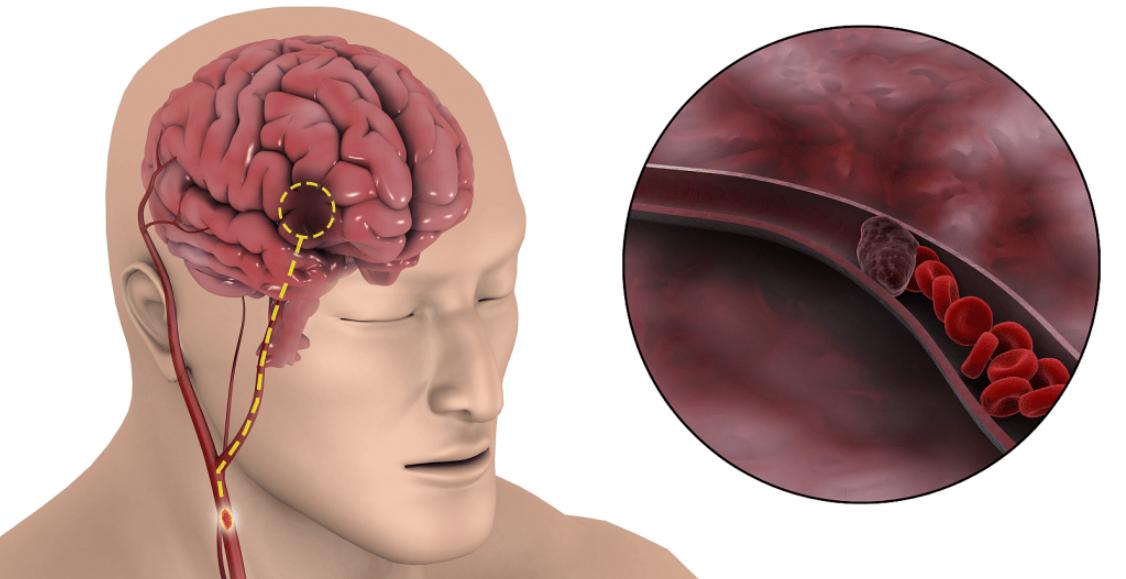 浅谈脑出血发病原因,脑出血好发于寒冷季节