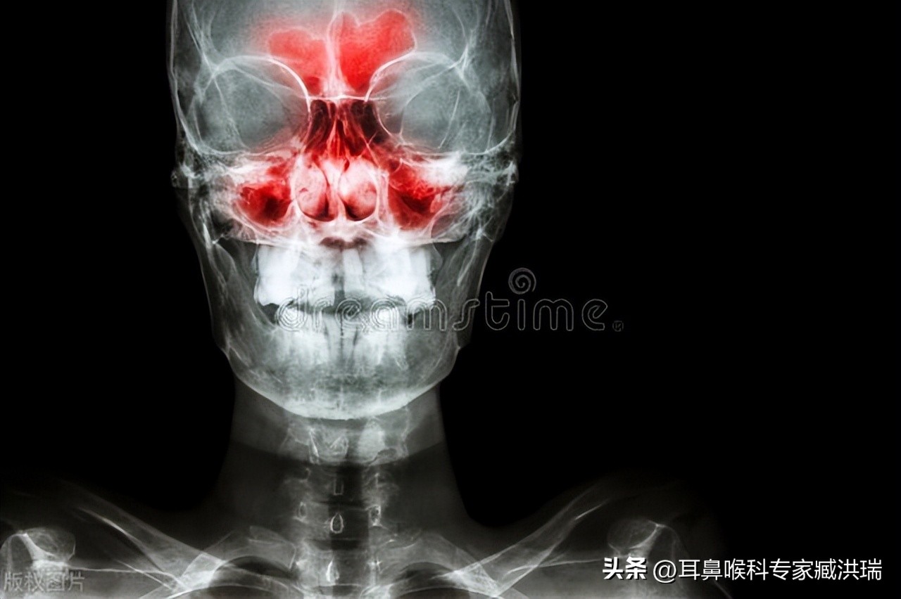 鼻炎和鼻窦炎的症状相似，但它们的病因和治疗方法不同