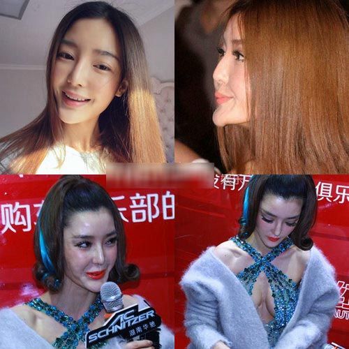 假下巴前后对比,假下巴