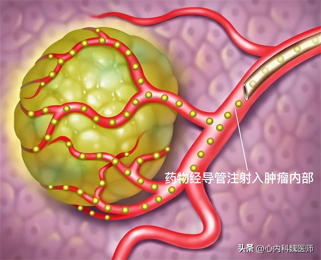 钇90微球疗法肝癌效果,钇90树脂微球治疗肝癌手术费用