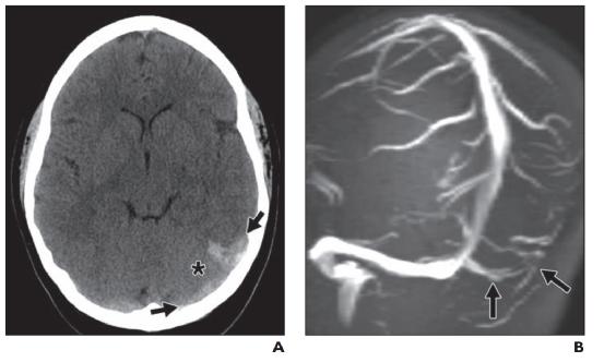 脑水肿的影像,脑水肿形成机制生理学