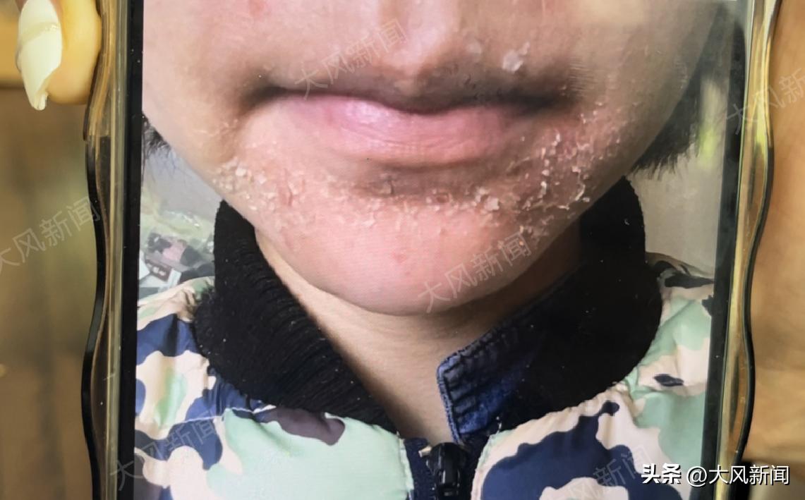 朋友圈买微商护肤品查出汞超标33万倍，多名女子投诉使用后头疼、烂肤、流产、甚至患上肿瘤，走上艰难维权路