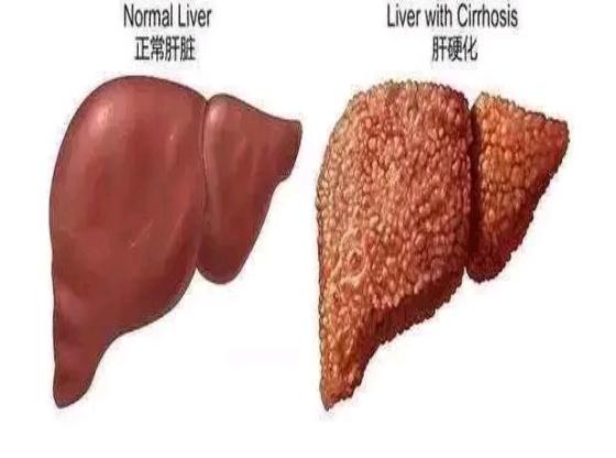 肝硬化身上长小红点痒是什么征兆,肝硬化脚面出了好多小红点有点肿