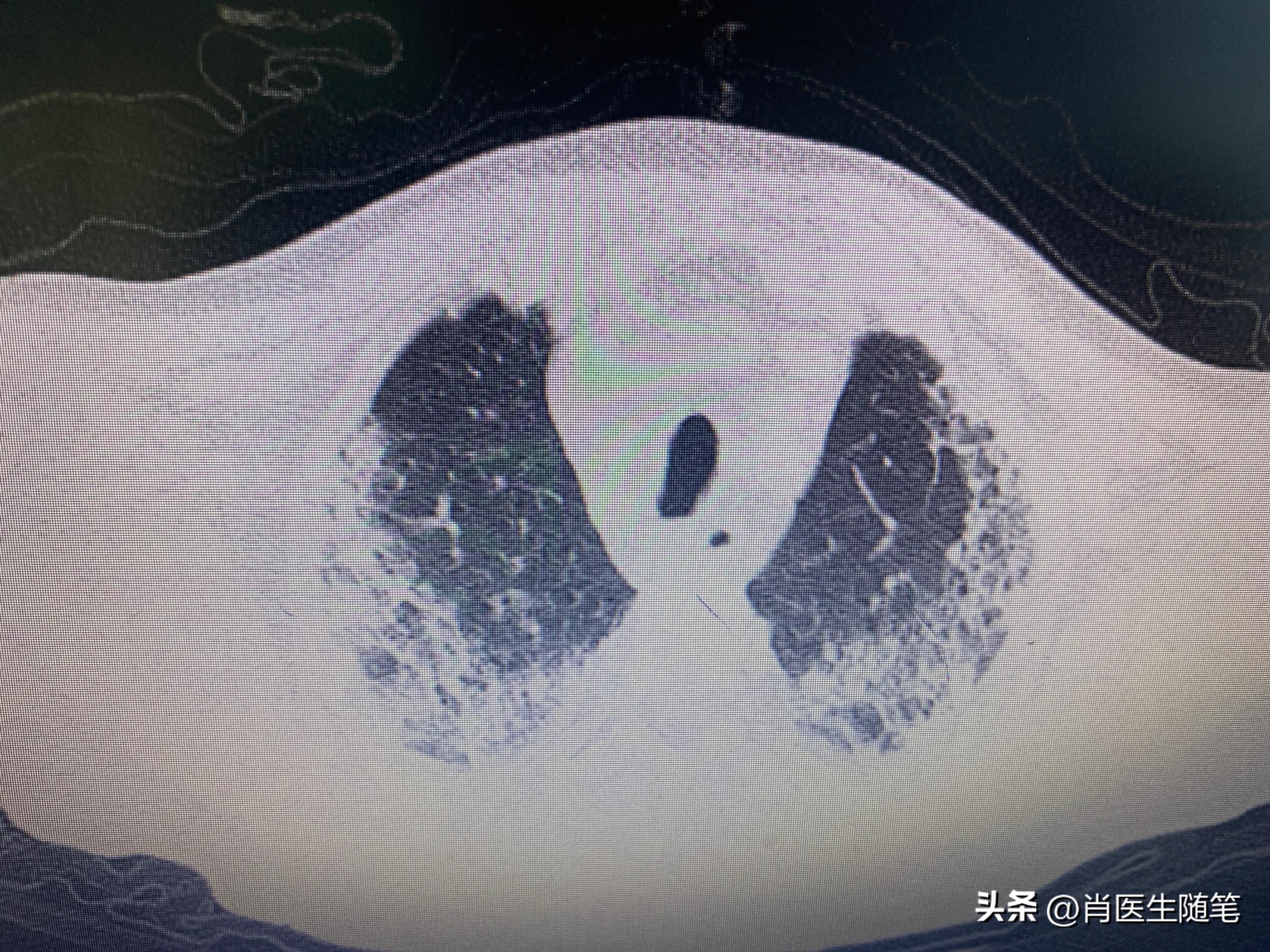 84岁老人白肺治好了,86岁老人得了大白肺还有救吗