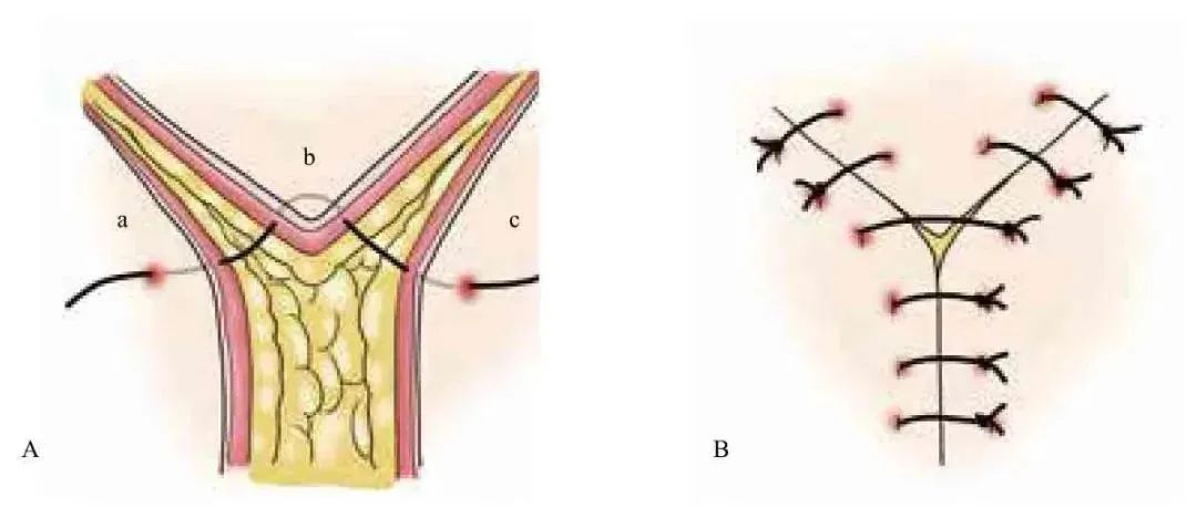 外科顶级缝针技术,外科缝合的操作细节你掌握多少