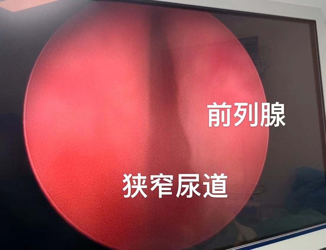 前列腺增生最终会怎么样？会血液透析吗？往往是自己拖出来的