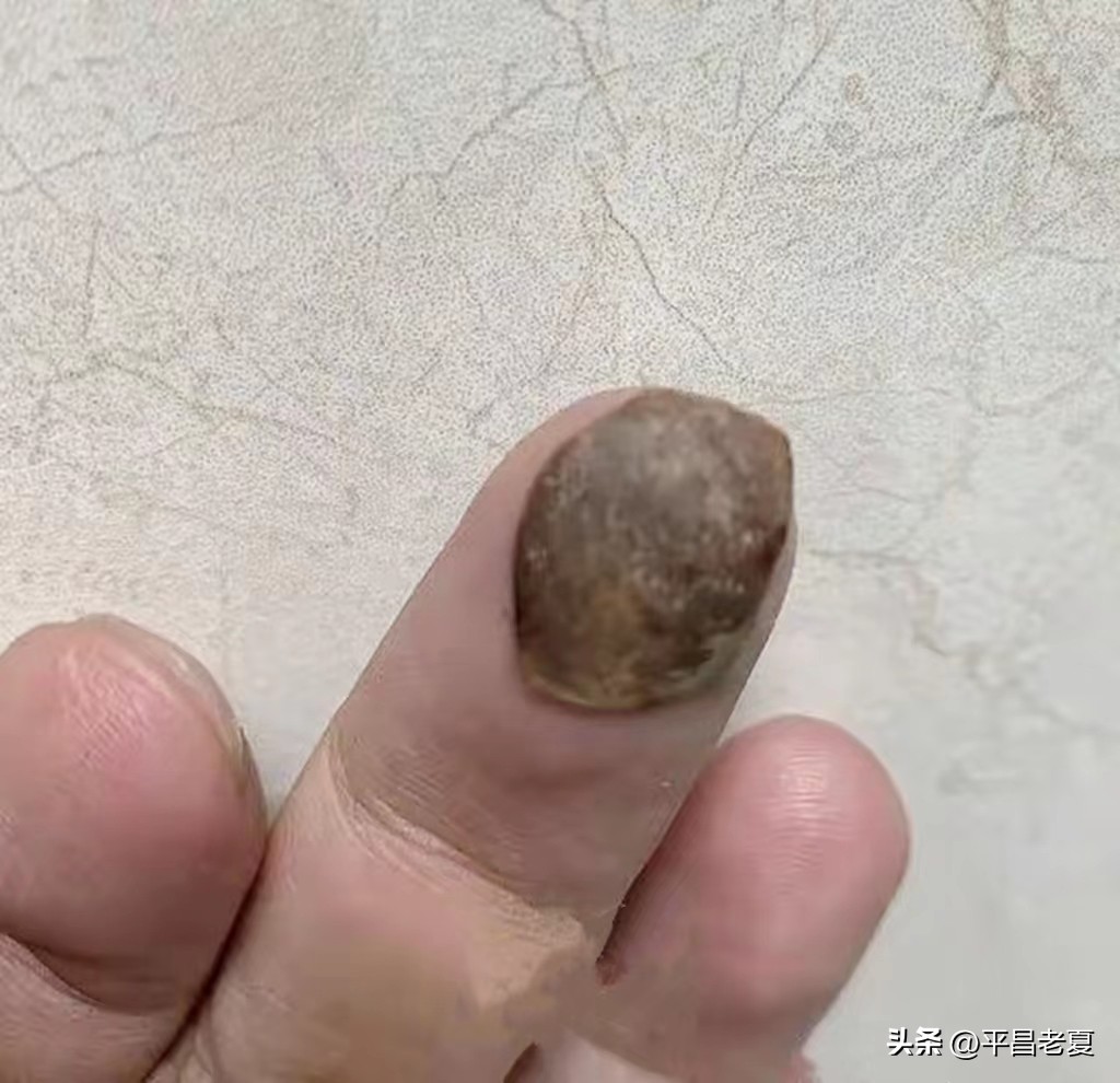 专家将莲子壳诊断为肿瘤后续,口腔莲子壳误诊成肿瘤后续