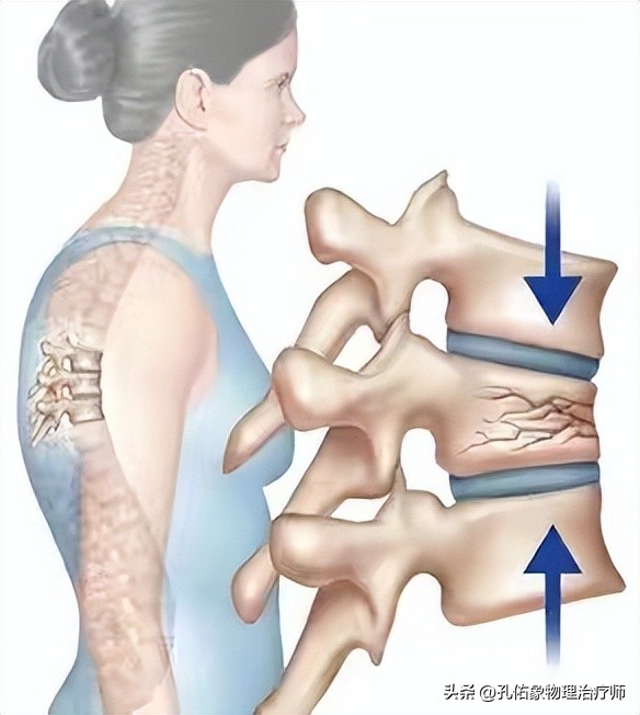 老年人压缩骨折能治好吗,腰椎压缩骨折腰部酸痛怎么办