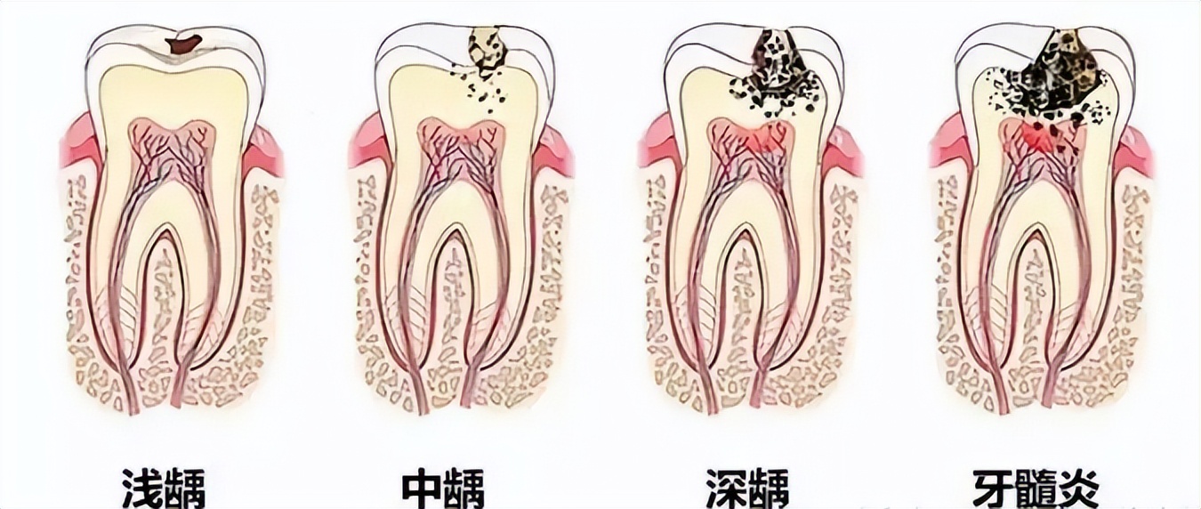 什么样的牙齿无药可救了,常见的牙齿的疾病和处理方法