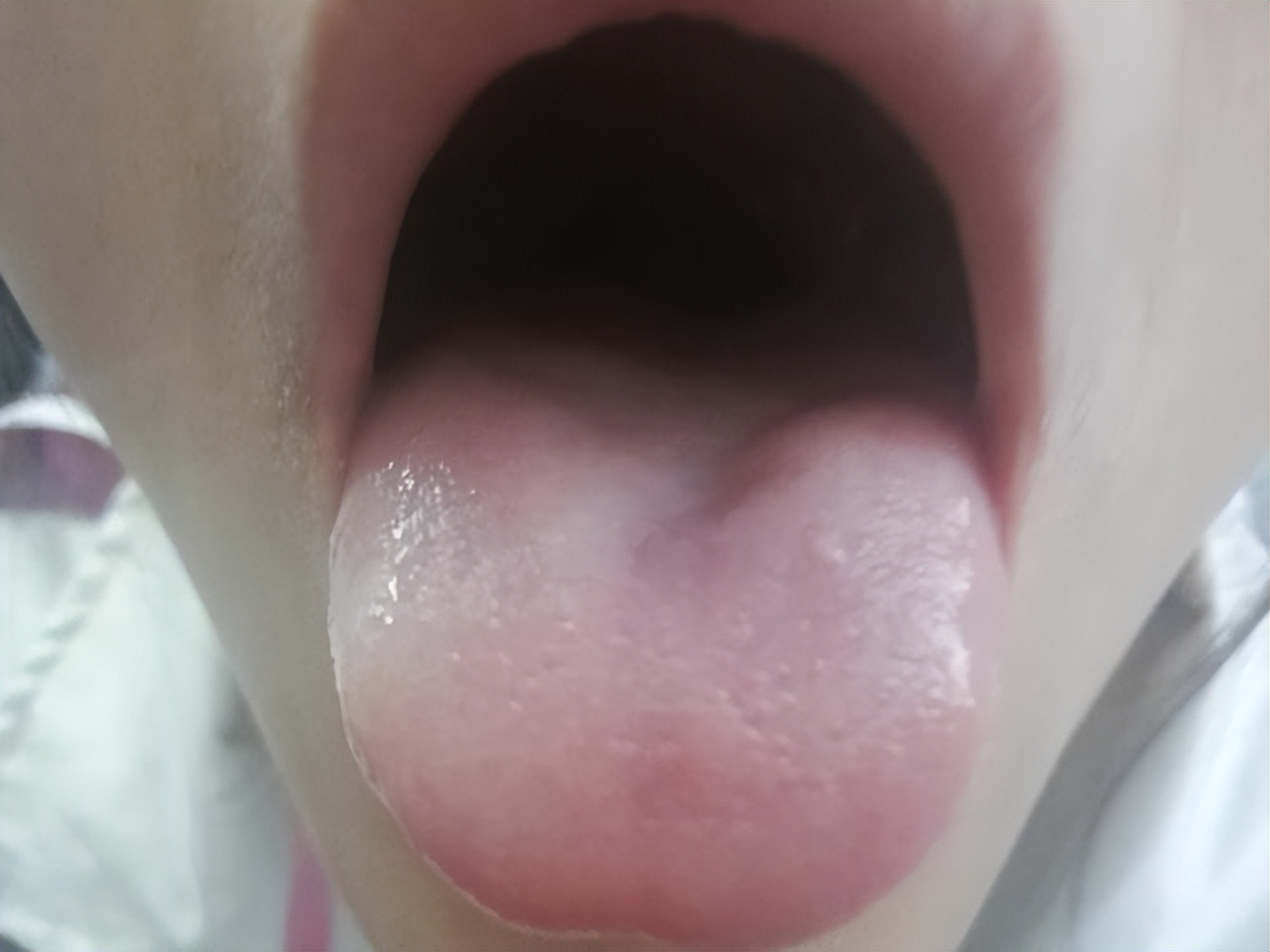 舌紫暗有瘀斑图片,舌紫是有瘀血吗