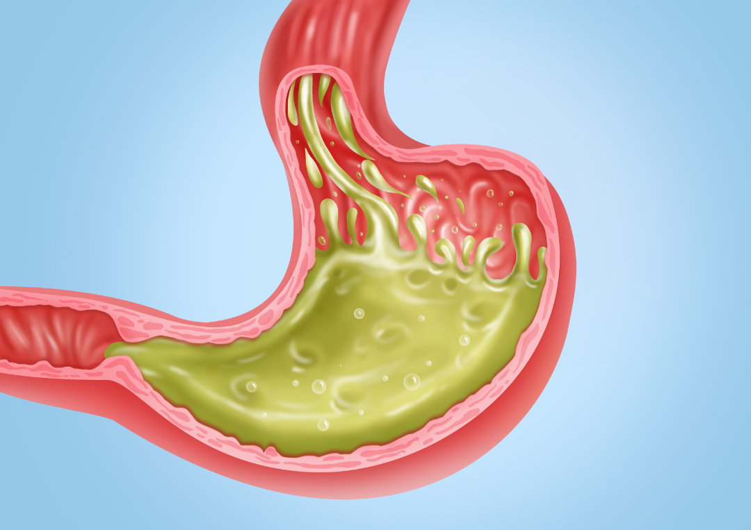 每个人都有慢性胃炎吗,每个人都有的基础胃病