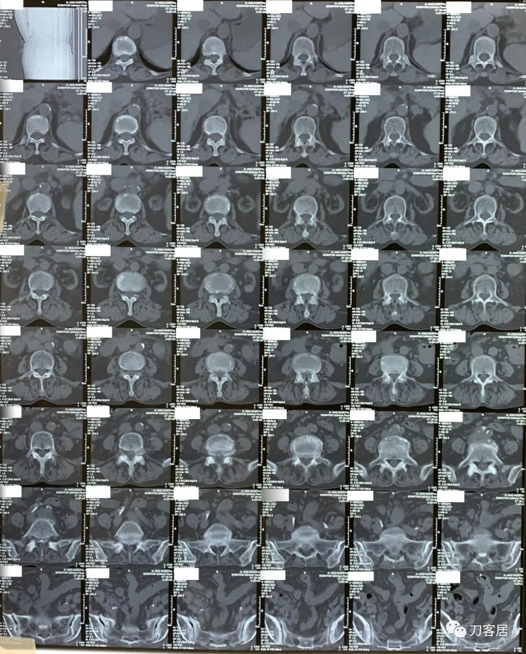 75岁老人腰间盘突出可以做手术吗,70岁老人腰间盘突出做手术