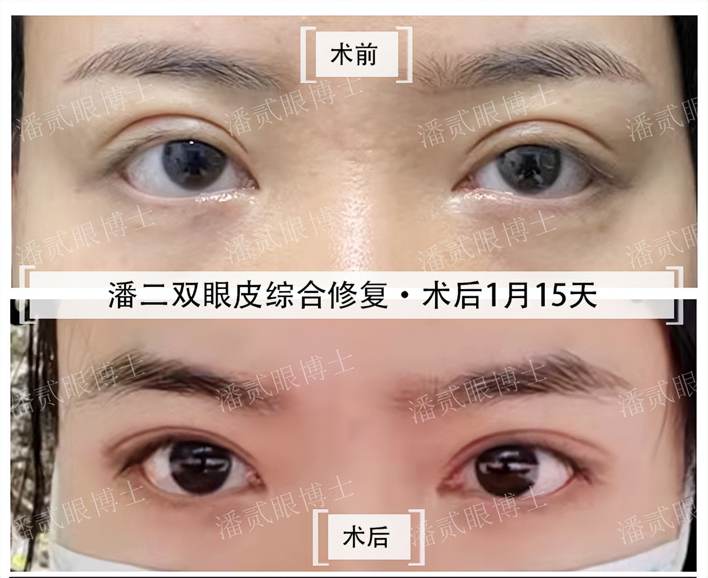 整容后眼睛不能闭合,整容失败眼睛无法闭合