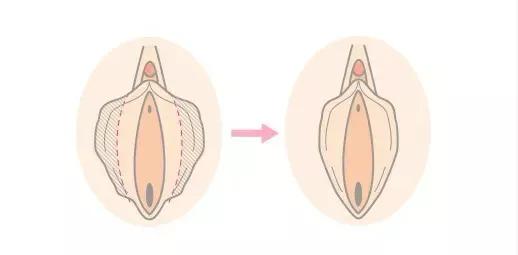 “私密整形”都包括哪些部位?