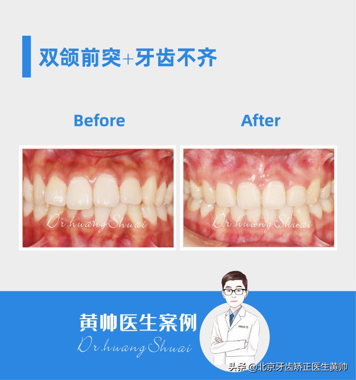 嘴凸的人怎么笑起来好看,嘴凸怎么让自己不焦虑