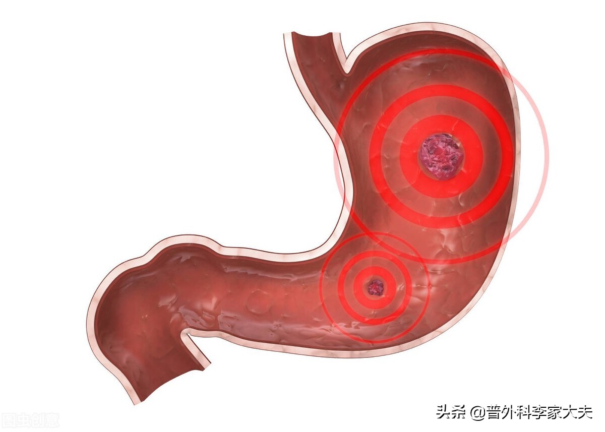 胃癌晚期会出现哪些征兆呢,胃癌晚期最严重的征兆