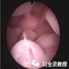 妇科专家教你认识宫腔镜,宫腔镜妇科主任
