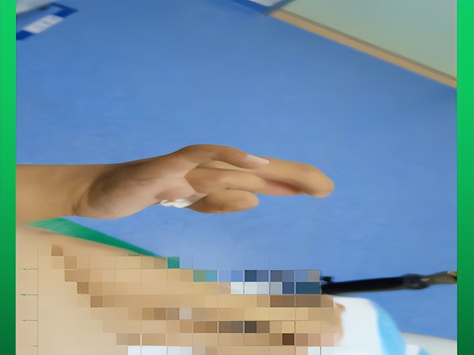 矮小症产妇一样可以享受到无痛分娩的好处了