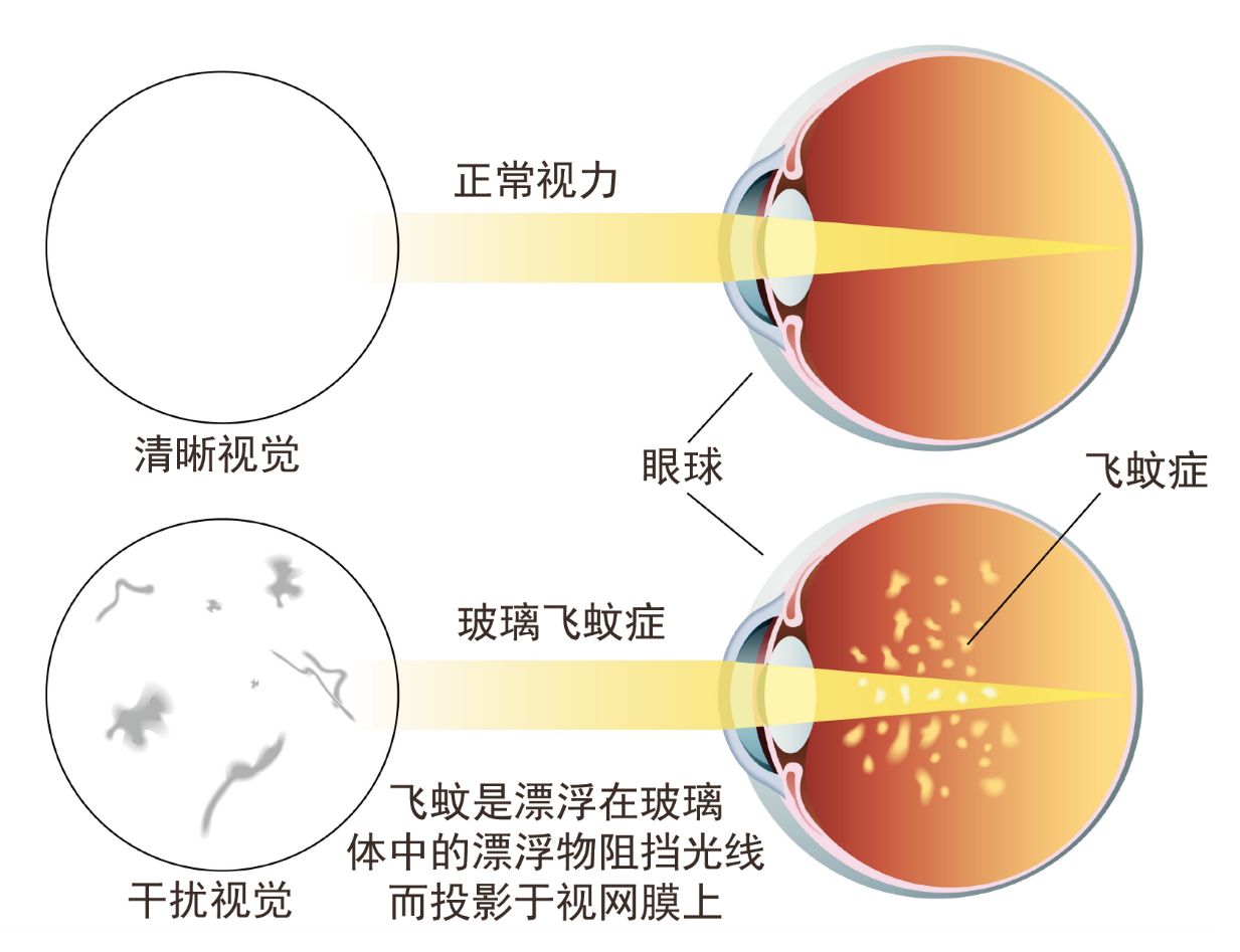 飞蚊症为什么容易失明,飞蚊症为什么近视就看不见了