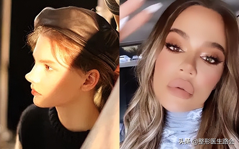 玻尿酸全脸填充年轻化,全脸玻尿酸填充真的会好看吗