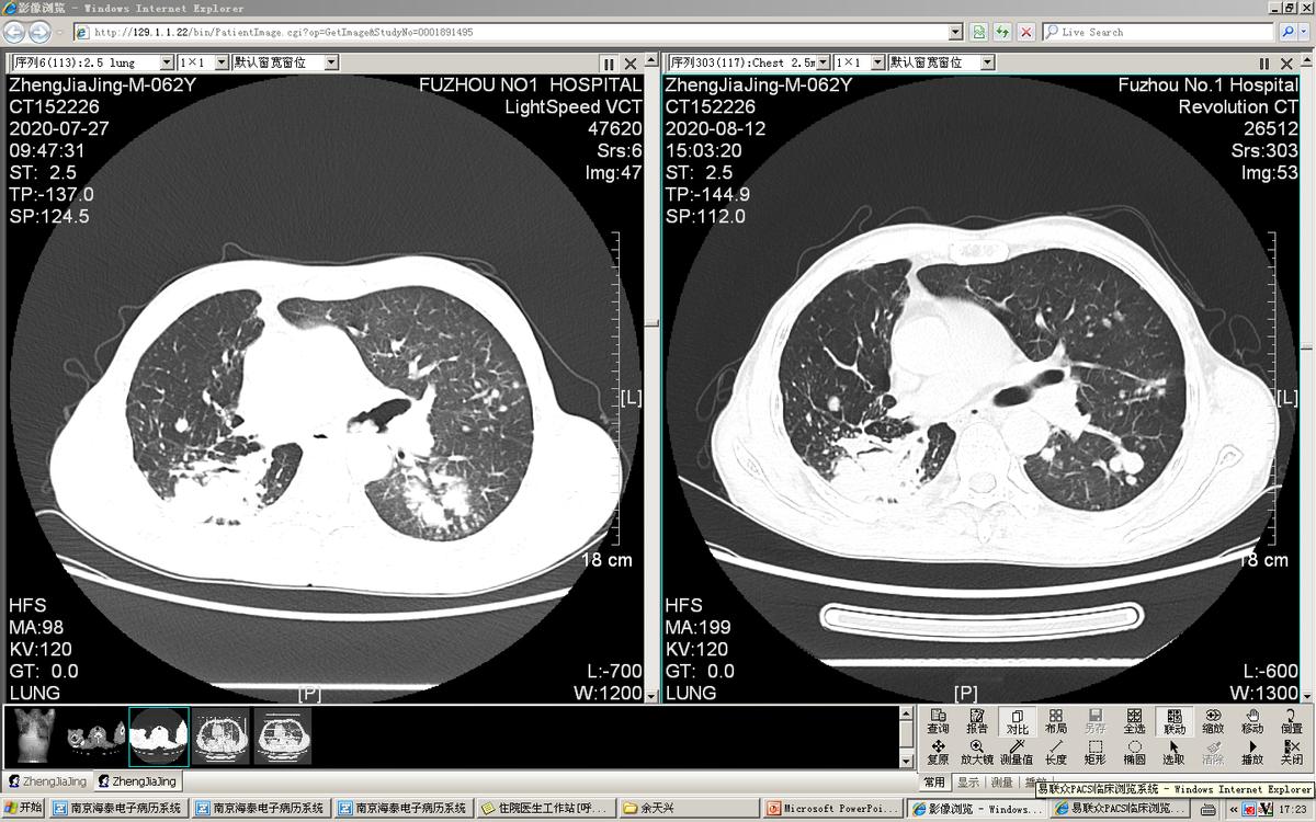 气管镜下肿瘤怎么治疗,气管肿物是什么