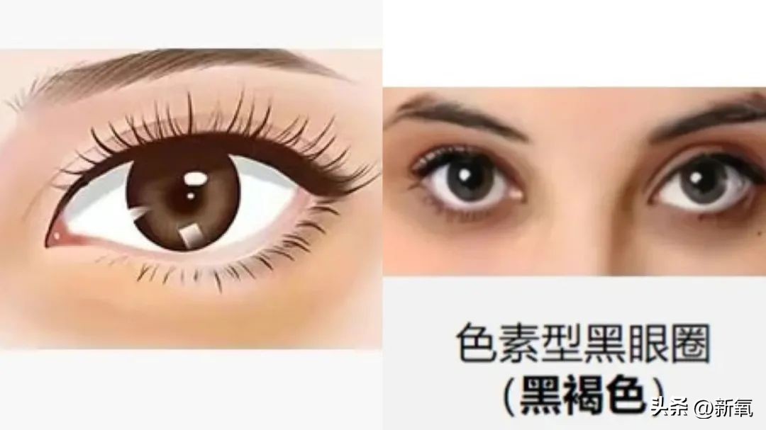 如何遮40岁黑眼圈眼袋泪沟,黑眼圈眼袋消除要按什么穴位