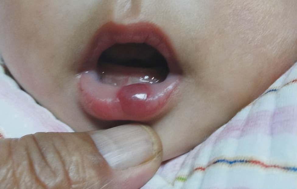 二个月婴儿脸上血管瘤一定会长大,血管瘤能不能等宝宝长大治疗