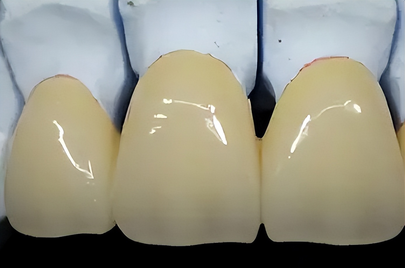 没有牙根怎么做烤瓷牙,做烤瓷牙后悔了有补救办法吗