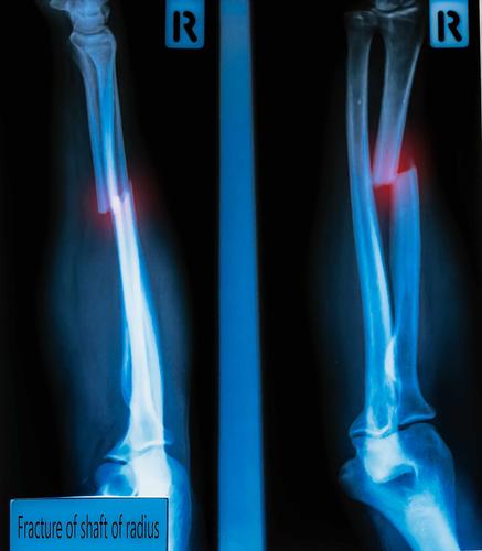 骨折后吃什么药更有利于骨折愈合,骨折术后70天弯曲不到位怎么修复