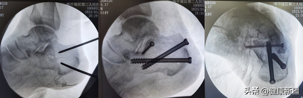 微创治疗搞定跟骨粉碎性骨折!