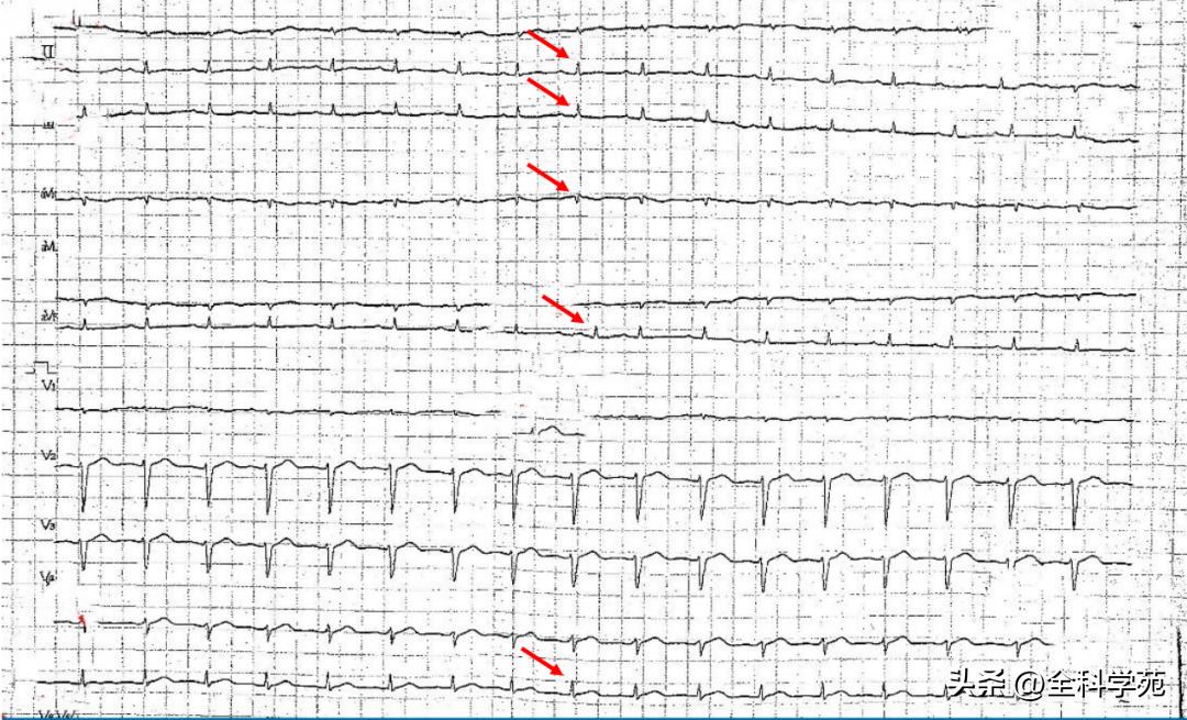 心电图qrs时限超宽是什么引起的,心电图qrs波呈m型见于什么疾病