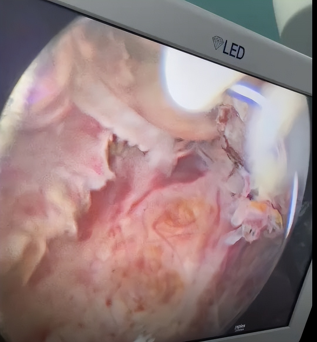 河南23岁宝妈大出血,28岁宝妈吃鸡蛋吃出宫颈癌