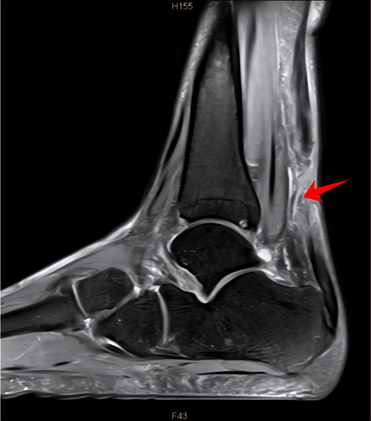 跟腱断裂对运动员的影响,运动员跟腱疼痛怎么解决