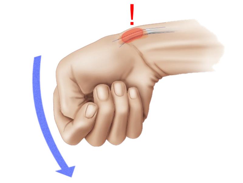 常玩手机手指痛小心得了腱鞘炎,玩手机腱鞘炎大拇指关节疼怎么办