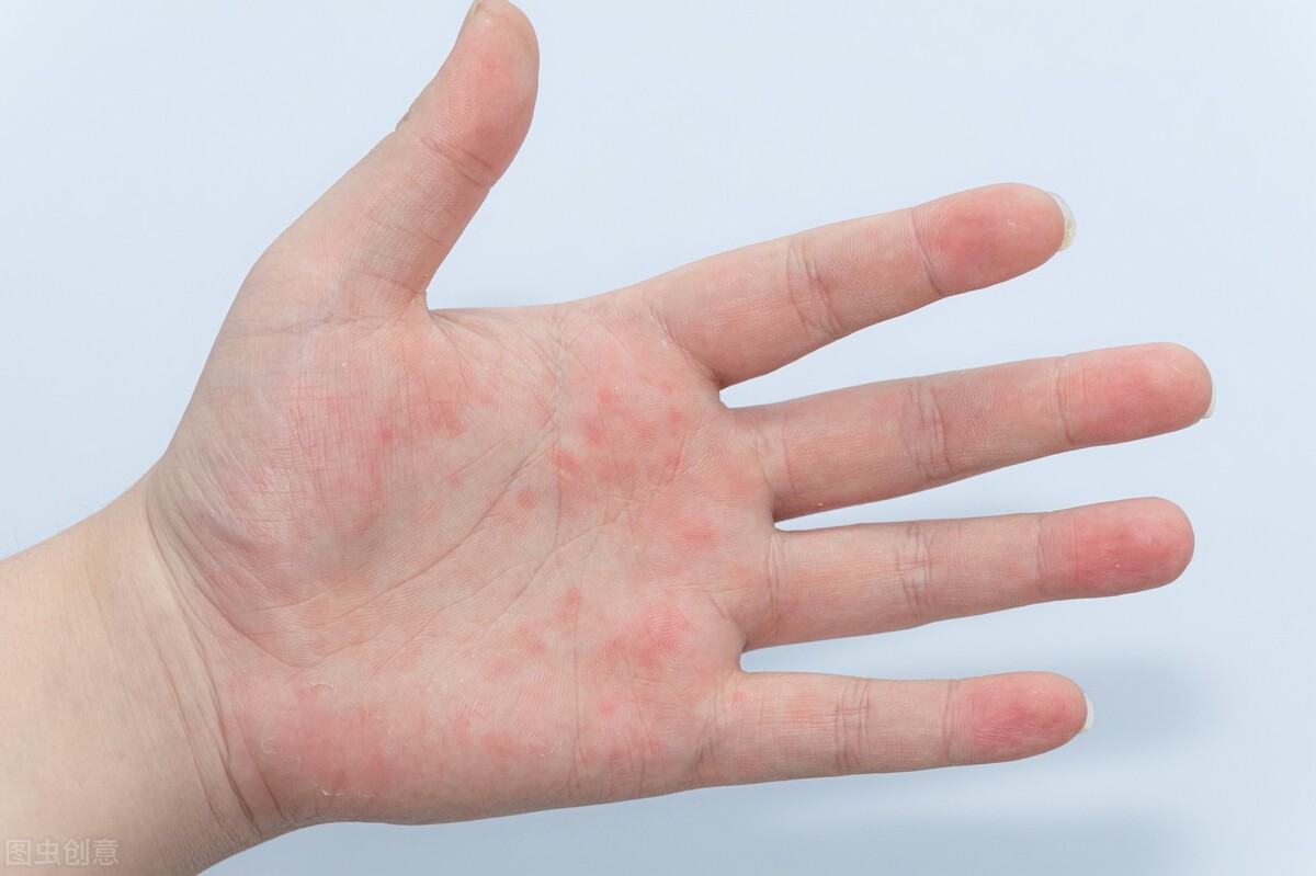 汗疱疹用什么药膏能彻底的治好了,汗疱疹怎样预防