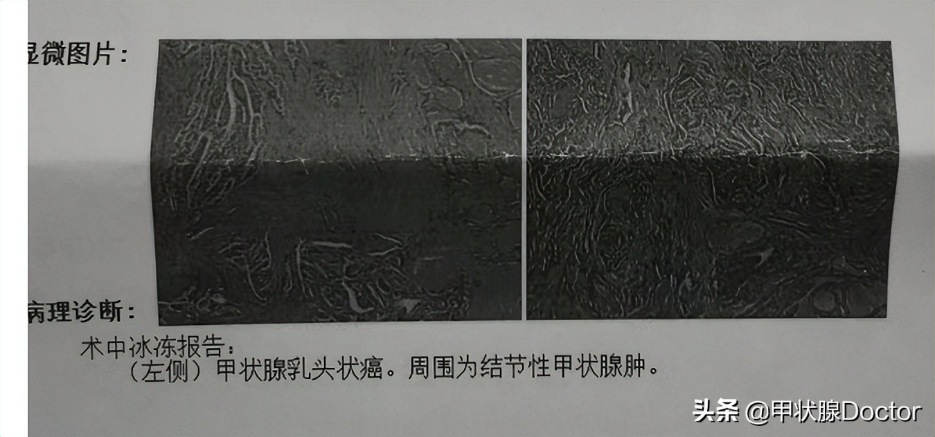 甲癌手术3个月后注意事项,甲癌术后5年生存期什么意思