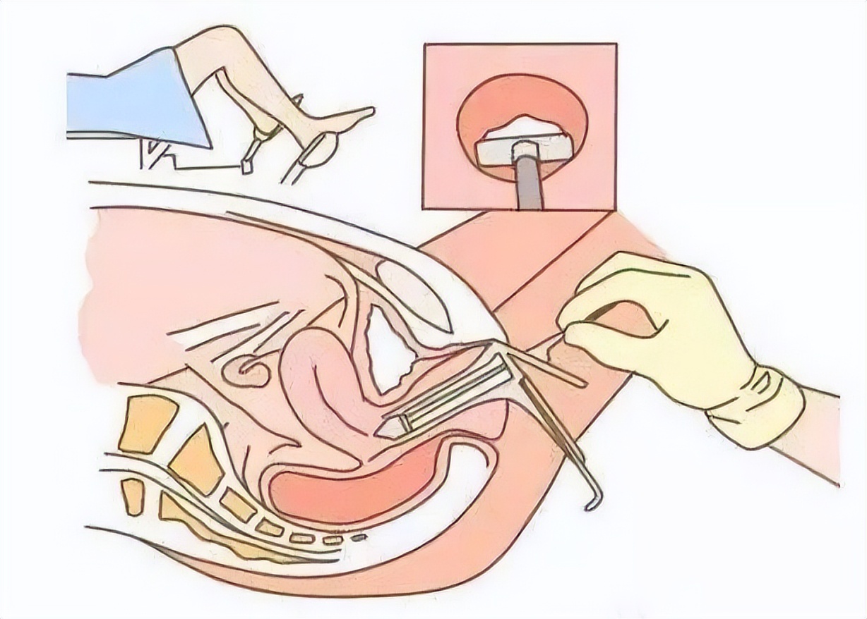 宫颈活检一般要夹几块肉出来,妇科活检需要打麻药吗
